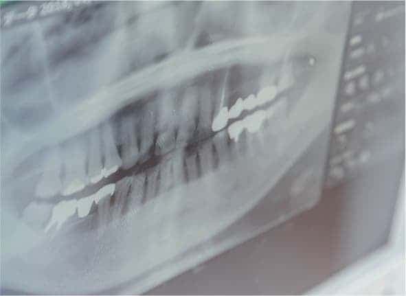 歯周病のCT画像