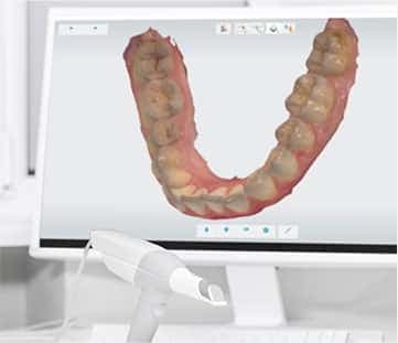 口腔内スキャナによる型取り